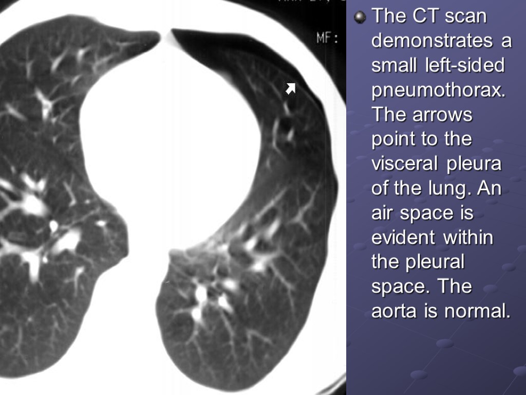 The CT scan demonstrates a small left-sided pneumothorax. The arrows point to the visceral